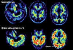 advances-in-treating-alzheimers-af
